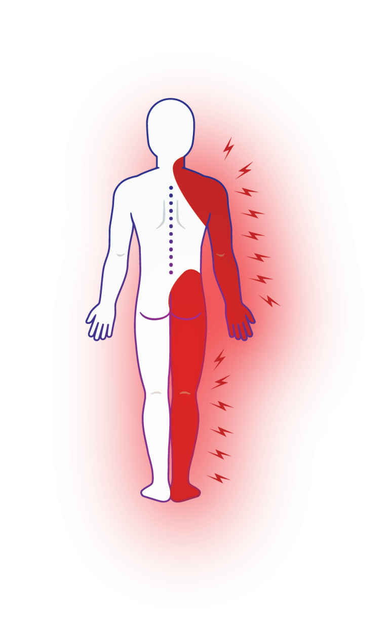 Radicular Pain Msk Pain